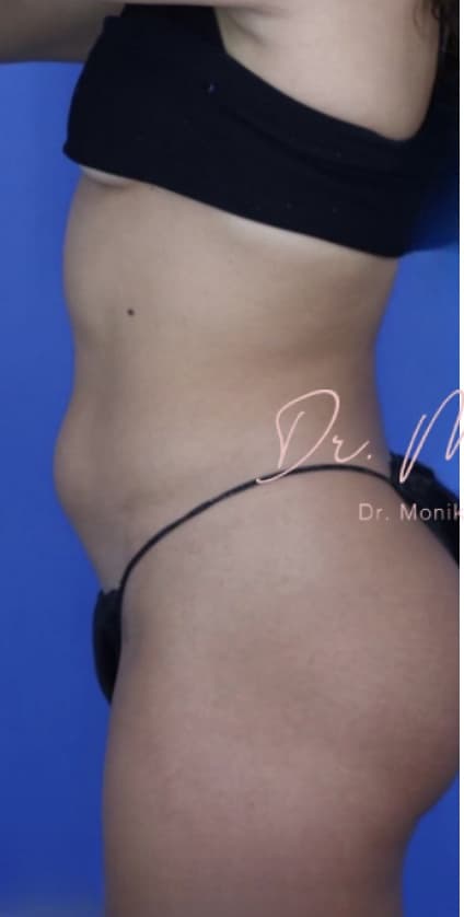 Before: Liposuction / Liposculpture Before & After Patient #670