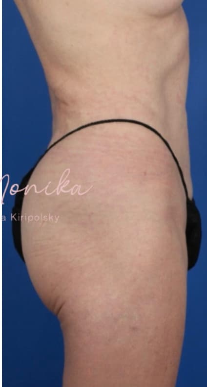 After: Liposuction / Liposculpture Before & After Patient #675