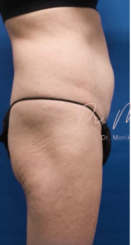Before: Liposuction / Liposculpture Before & After Patient #675
