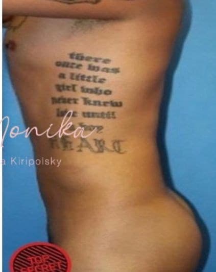 After: Liposuction / Liposculpture Before & After Patient #676