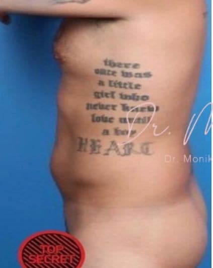 Before: Liposuction / Liposculpture Before & After Patient #676