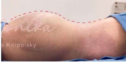 After: Liposuction / Liposculpture Before & After Patient #677
