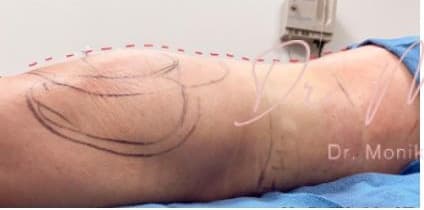 Before: Liposuction / Liposculpture Before & After Patient #677