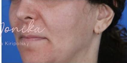 After: Melasma Before & After Patient #1535