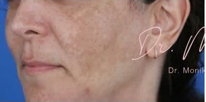Before: Melasma Before & After Patient #1535