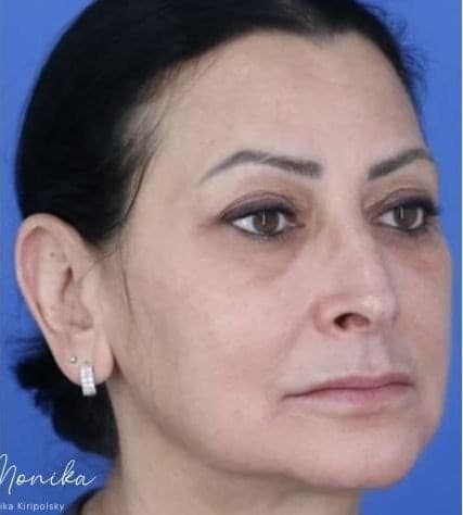 After: Melasma Before & After Patient #2061