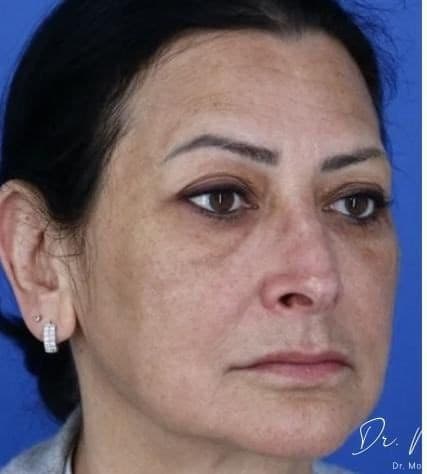 Before: Melasma Before & After Patient #2061