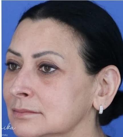 After: Melasma Before & After Patient #2061