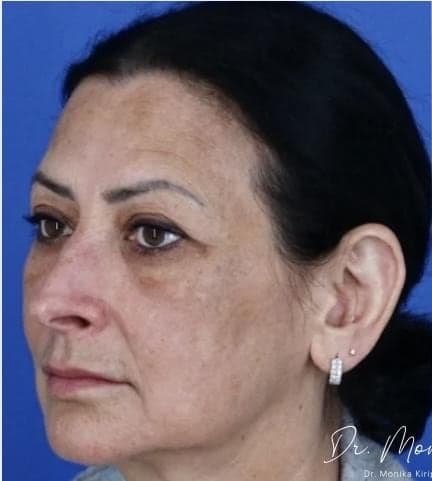 Before: Melasma Before & After Patient #2061