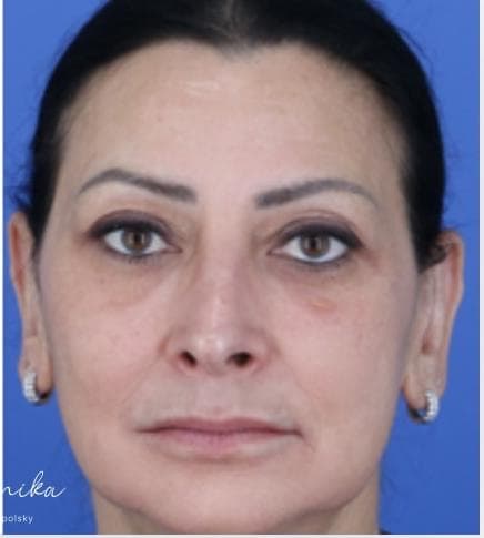 After: Melasma Before & After Patient #2061