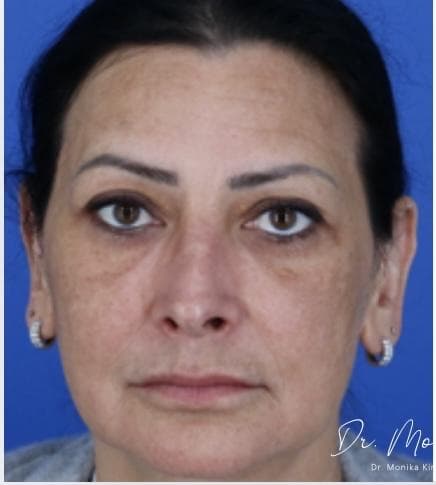 Before: Melasma Before & After Patient #2061