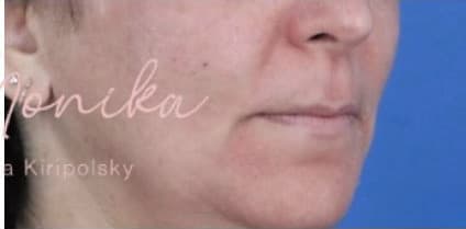 After: Melasma Before & After Patient #651