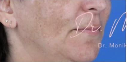 Before: Melasma Before & After Patient #651