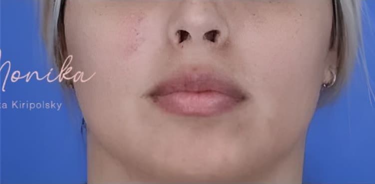 After: Mole & Melanoma Removal Before & After Patient #2051