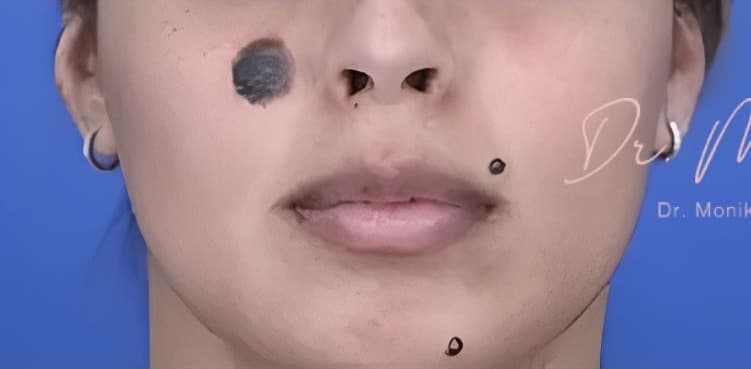Before: Mole & Melanoma Removal Before & After Patient #2051