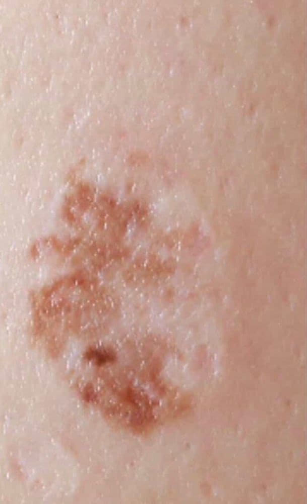 Before: Mole & Melanoma Removal Before & After Patient #2212