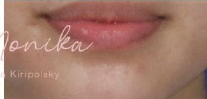After: Mole & Melanoma Removal Before & After Patient #536