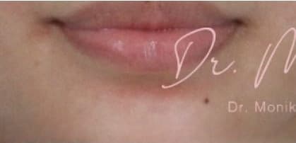 Before: Mole & Melanoma Removal Before & After Patient #536