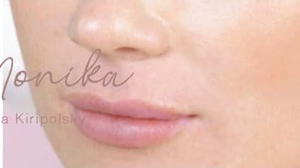 After: Lip Filler Before & After Patient #558