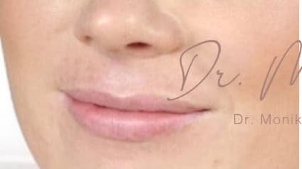 Before: Lip Filler Before & After Patient #558