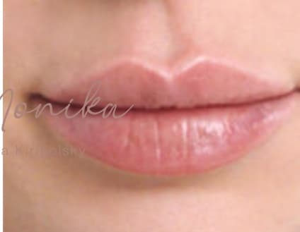 After: Lip Filler Before & After Patient #559