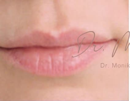 Before: Lip Filler Before & After Patient #559