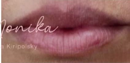 After: Lip Filler Before & After Patient #560