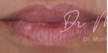 Before: Lip Filler Before & After Patient #560
