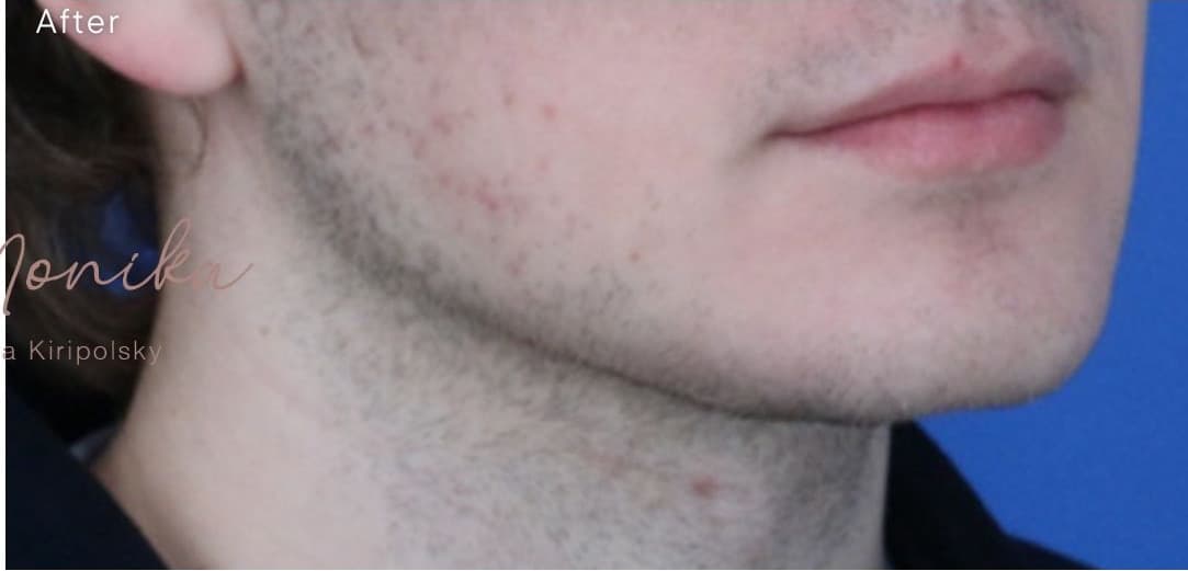 After: Chin & Jawline Facial Rebalancing Before & After Patient #1900