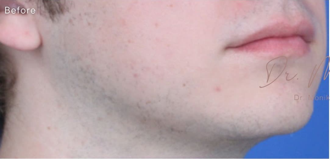 Before: Chin & Jawline Facial Rebalancing Before & After Patient #1900