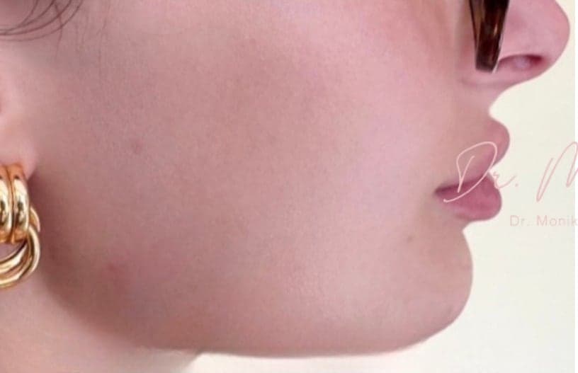 Before: Chin & Jawline Facial Rebalancing Before & After Patient #2195
