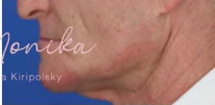 After: Chin & Jawline Facial Rebalancing Before & After Patient #577