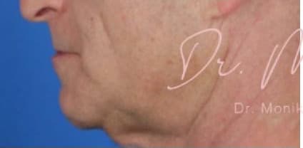 Before: Chin & Jawline Facial Rebalancing Before & After Patient #577