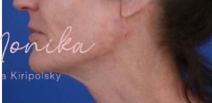 After: Chin & Jawline Facial Rebalancing Before & After Patient #578