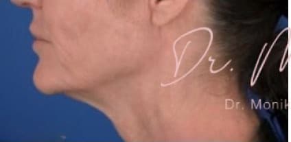 Before: Chin & Jawline Facial Rebalancing Before & After Patient #578