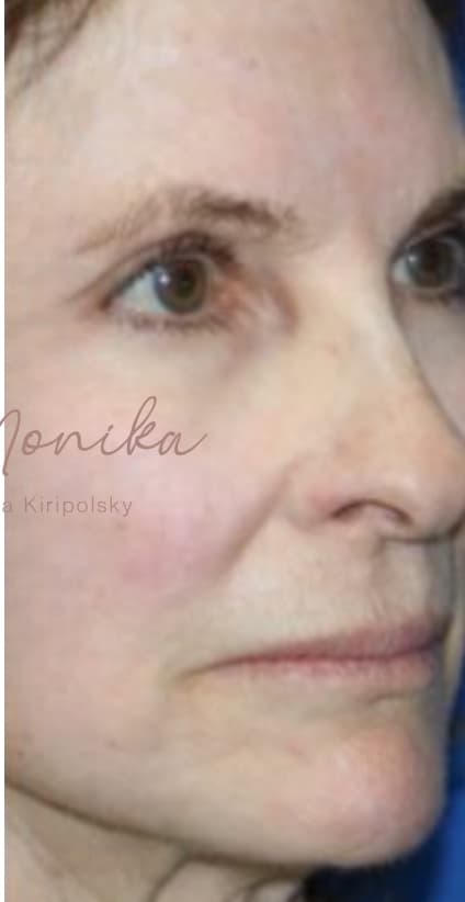 After: Chin & Jawline Facial Rebalancing Before & After Patient #579