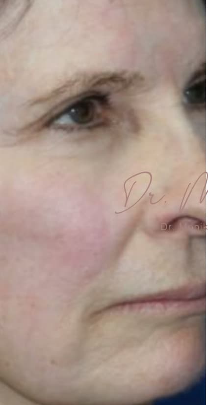 Before: Chin & Jawline Facial Rebalancing Before & After Patient #579