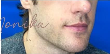 After: Chin & Jawline Facial Rebalancing Before & After Patient #580