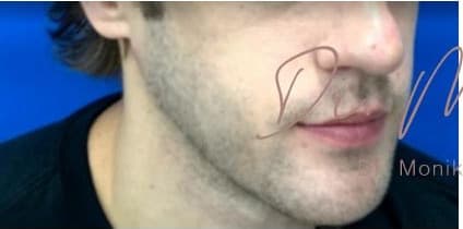 Before: Chin & Jawline Facial Rebalancing Before & After Patient #580