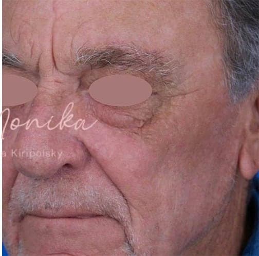After: Skin Rejuvenation Before & After Patient #808