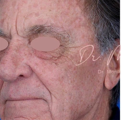 Before: Skin Rejuvenation Before & After Patient #808