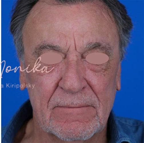 After: Skin Rejuvenation Before & After Patient #808