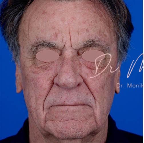 Before: Skin Rejuvenation Before & After Patient #808