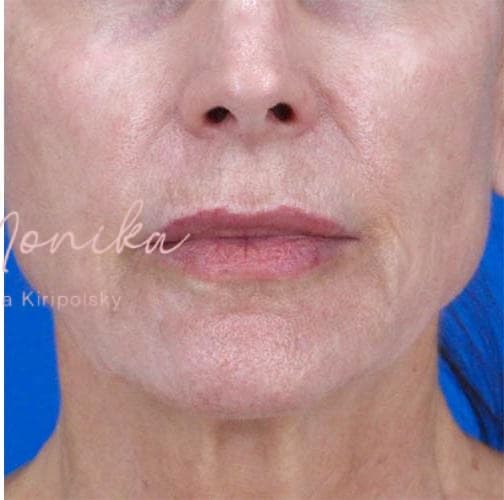 After: Skin Rejuvenation Before & After Patient #821