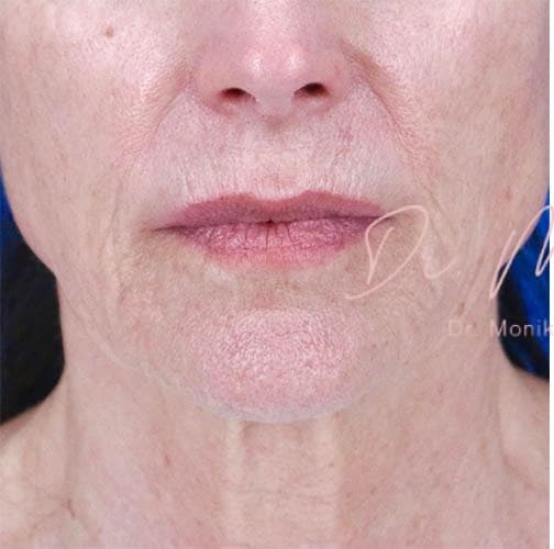 Before: Skin Rejuvenation Before & After Patient #821