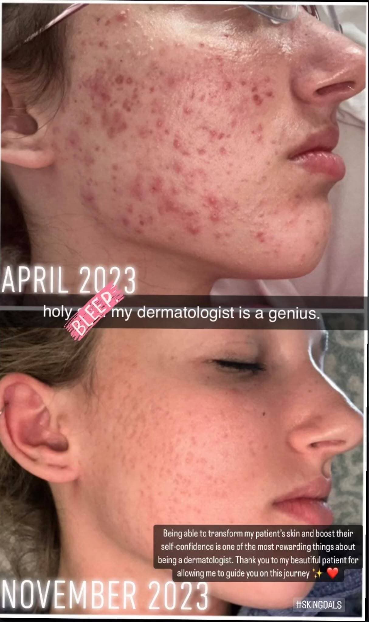 Instagram story: a patient’s acne before and after, April 2023 next to November 2023, treated by Dr. Monika