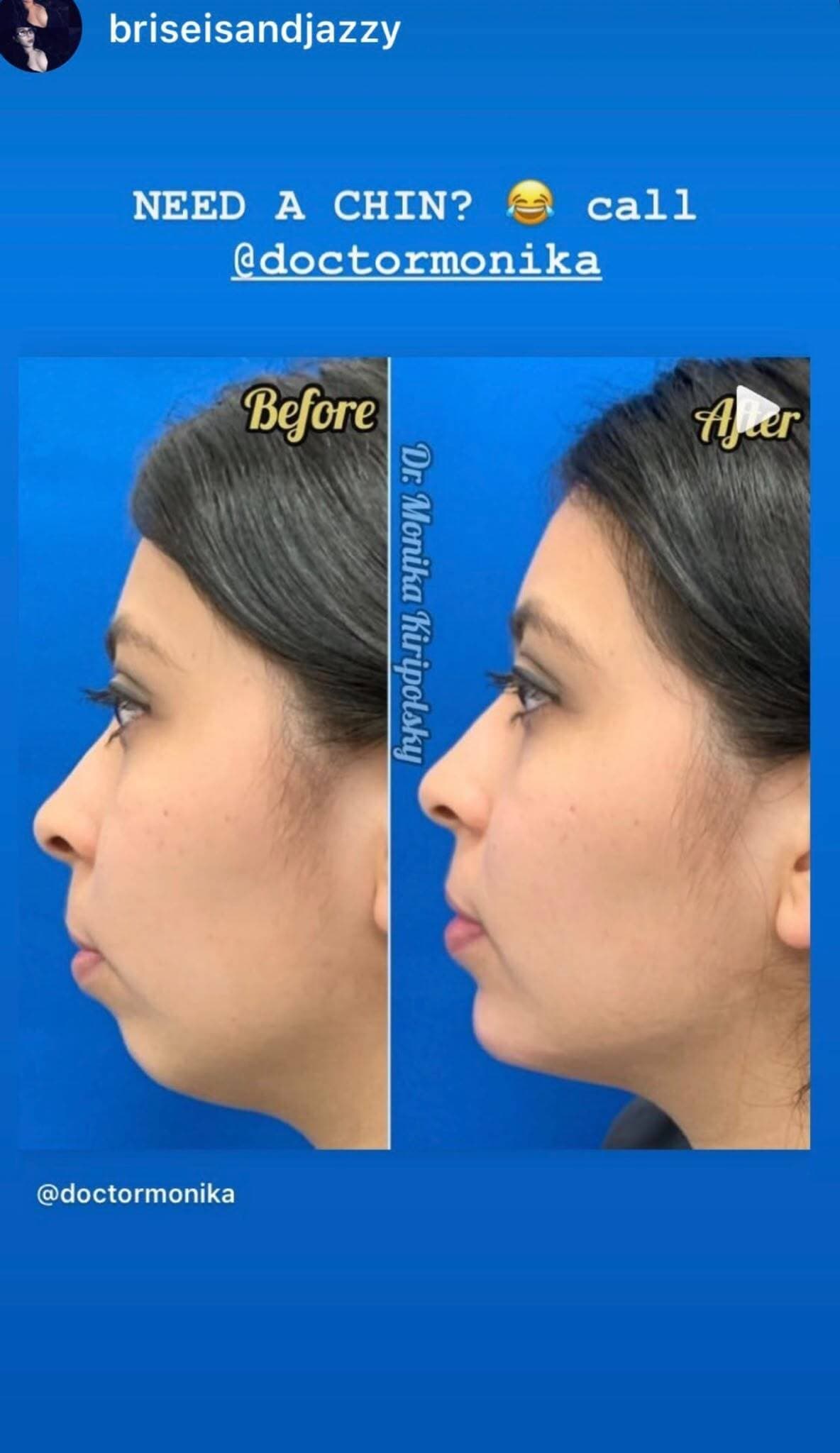 Instagram story from @briseisandjazzy: a chin profile before and after, treated by Dr. Monika