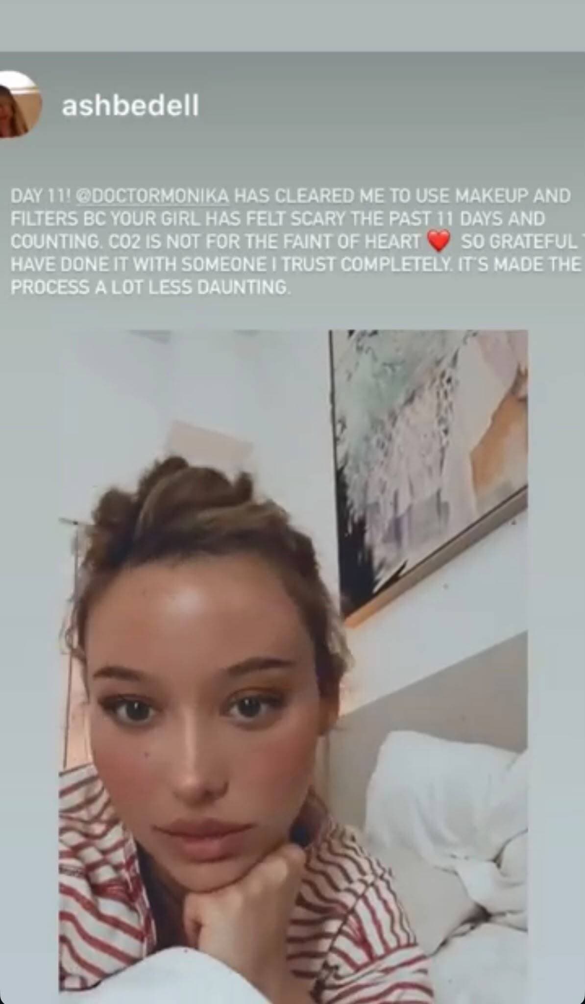 Instagram story from @ashbedell: day 11 of CO₂ laser recovery with Dr. Monika