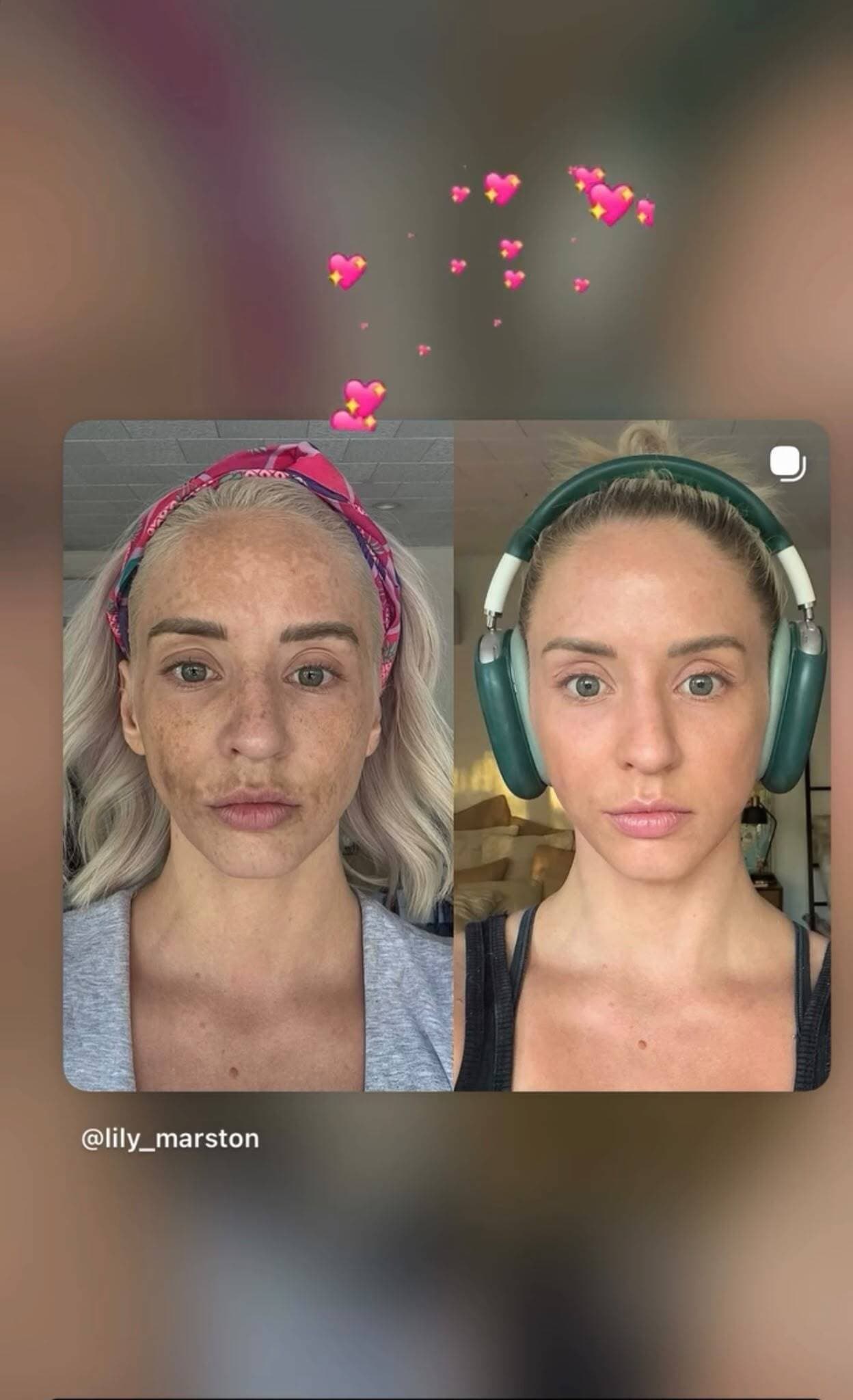 Instagram story from @lily_marston: pigmentation before and after, treated by Dr. Monika