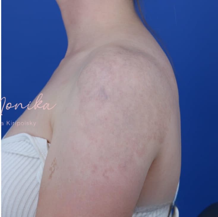 After: Tattoo Removal Before & After Patient #1672